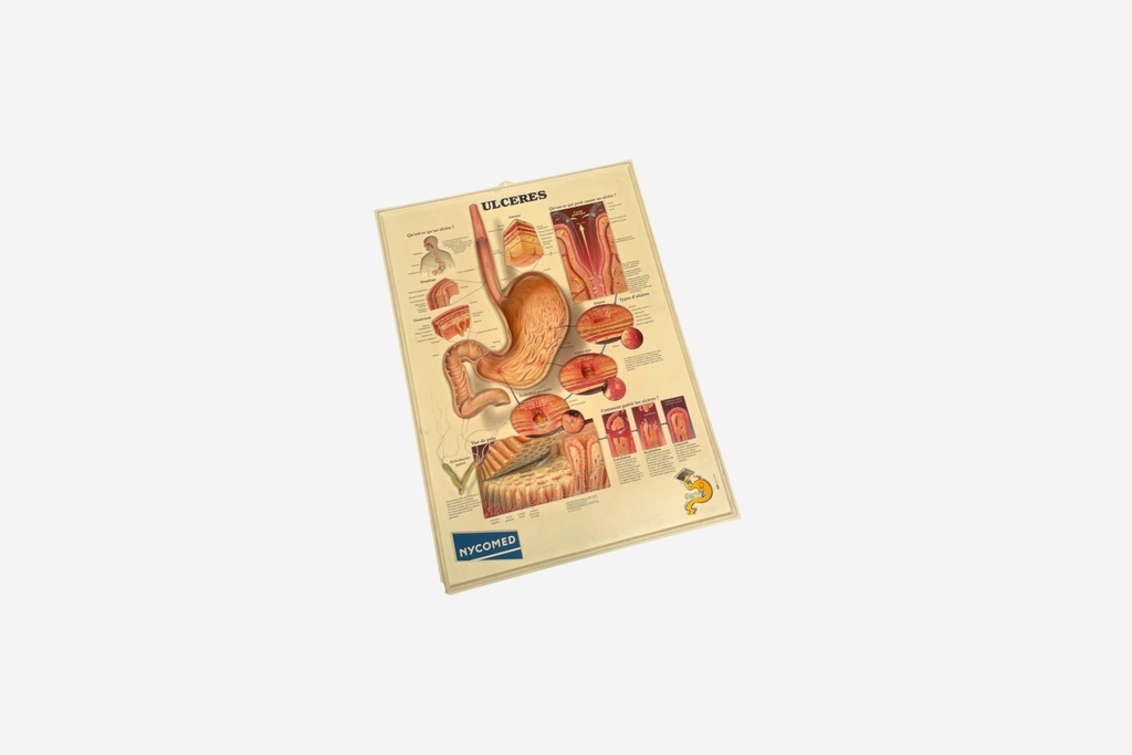 Vintage Anatomical Ulcer Diagram Chart